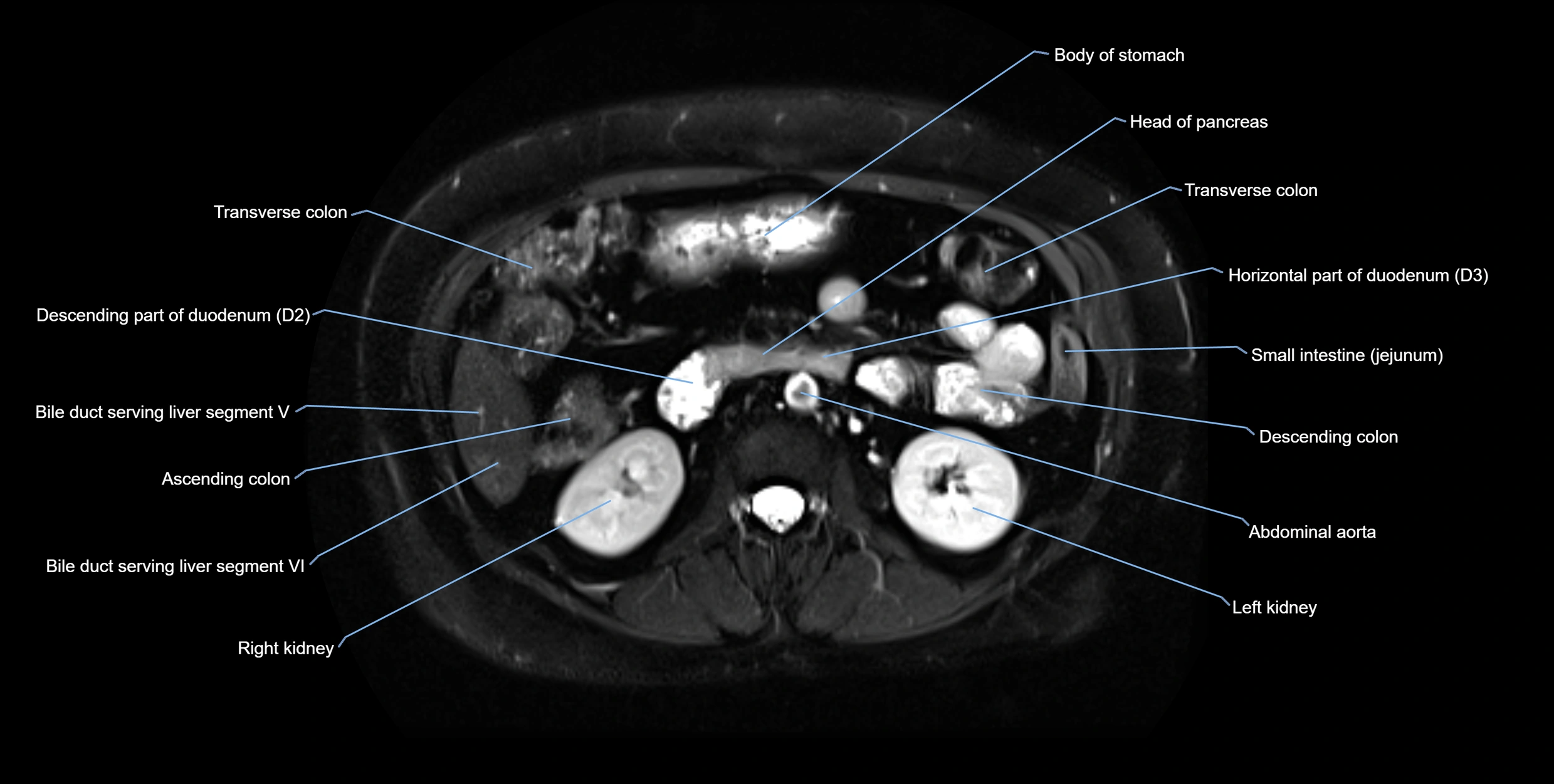 MRI MRCP axial cross sectional anatomy 3T radiology  image-img-10001-00030.webp